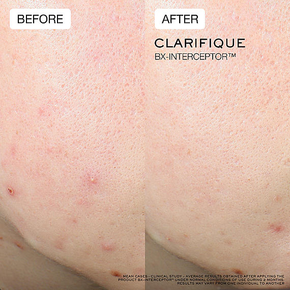 Lancome Clarifique Bx-Interceptor Akne Karşıtı Serum 30 Ml - 5